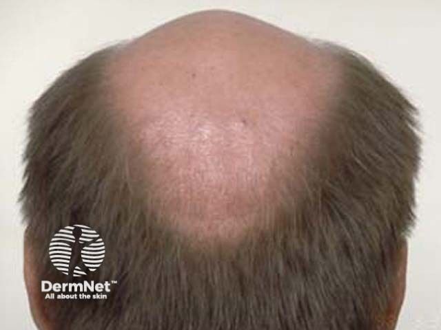 Dermatology Times coverage of the hair loss pipeline