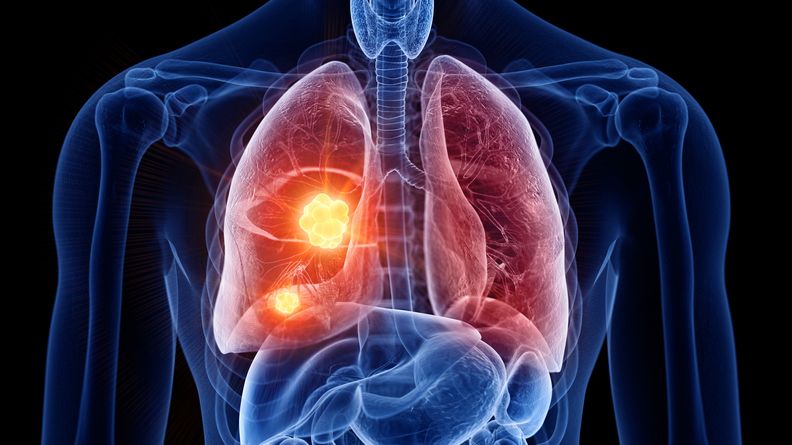 Lung cancer slide image illustrating cfDNA liquid biopsy clinical utility research