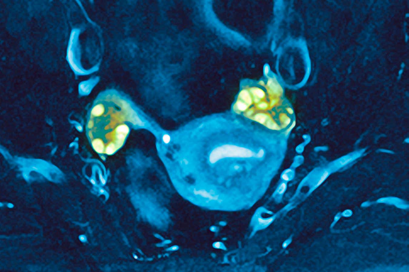 Ultrasound image illustrating PCOS-related research on perimenopause timing
