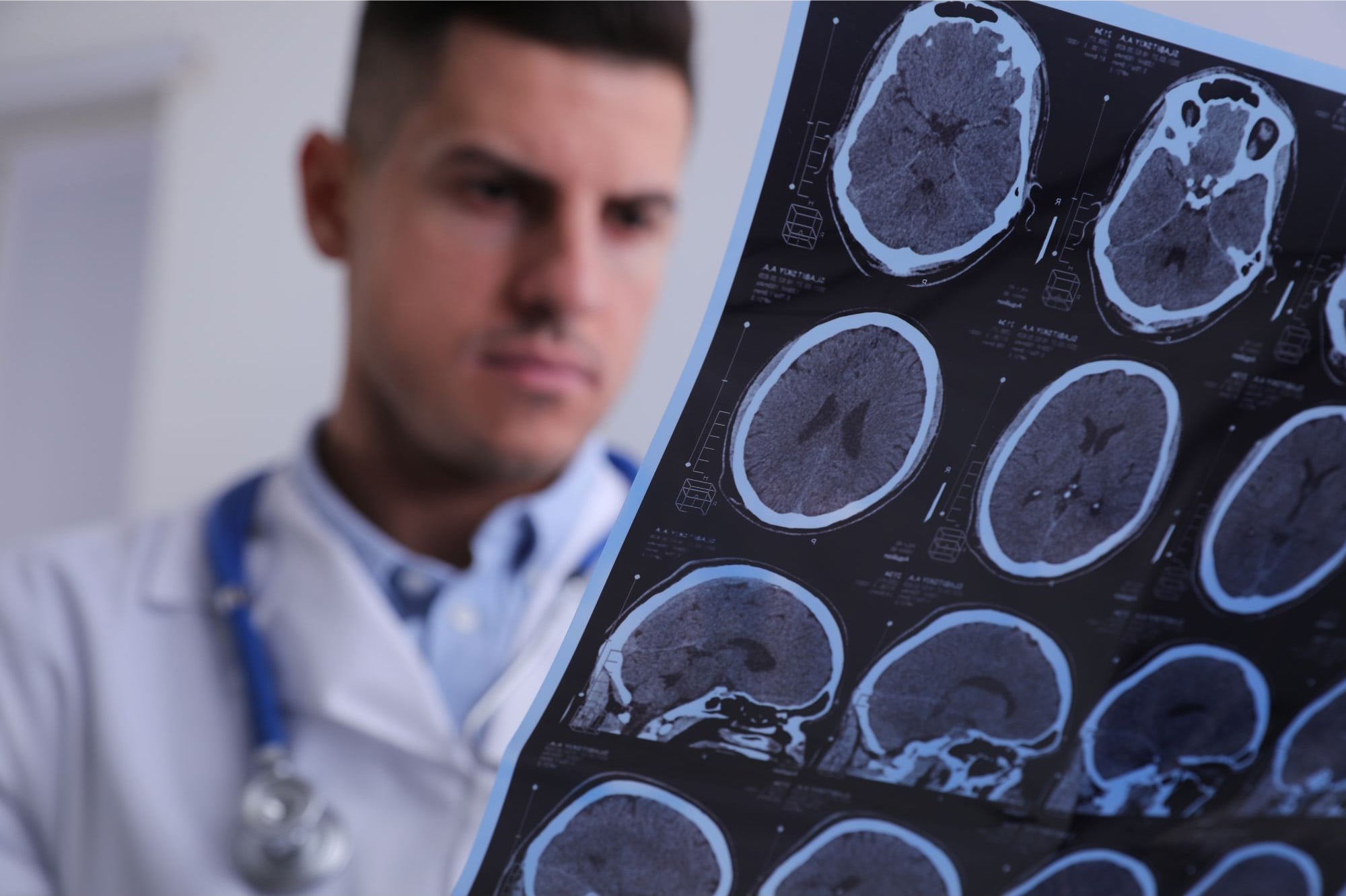 MRI brain imaging showing structural changes