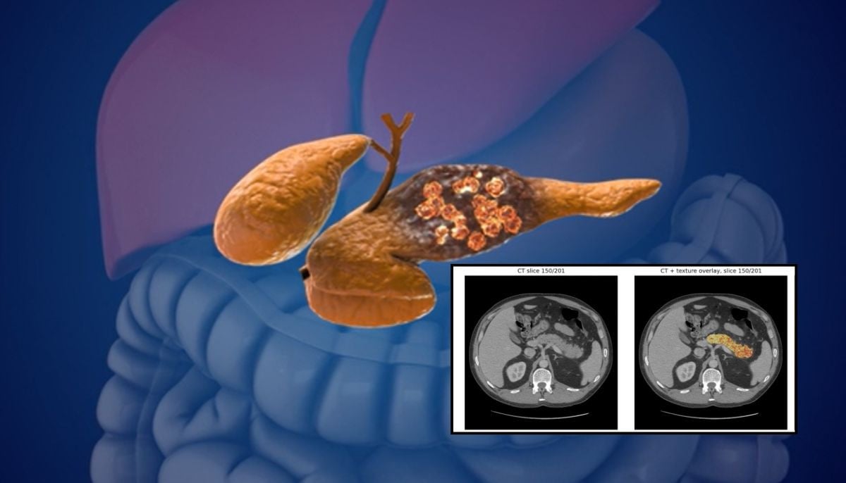 Clinical image showing Mayo Clinic's AI early pancreatic cancer detection results