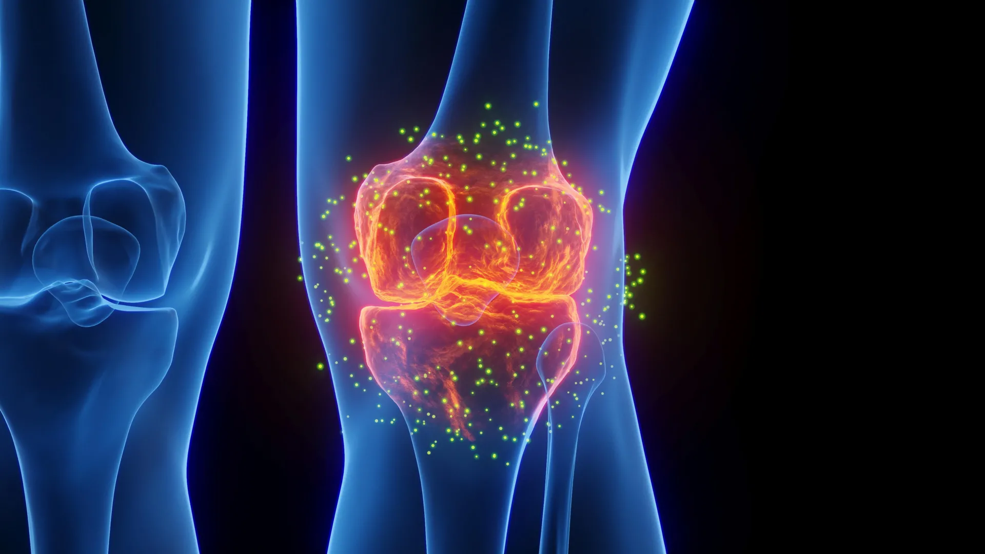 3D illustration of a healthy knee joint compared to one affected by osteoarthritis inflammation