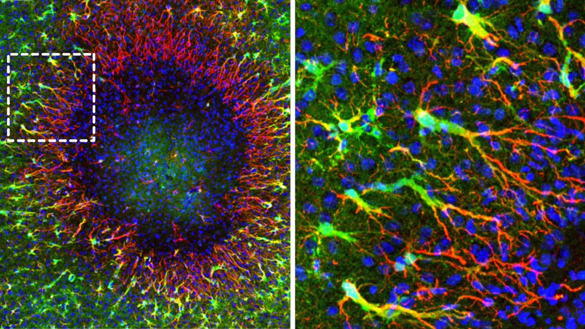 Illustration of a brain lesion surrounded by regenerative astrocytes