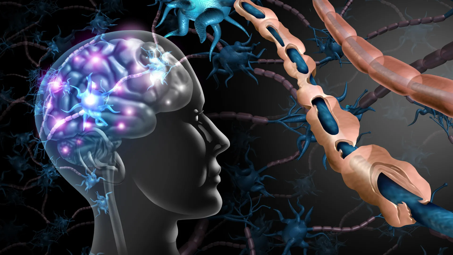 Image of multiple sclerosis nerve disorder and damaged myelin
