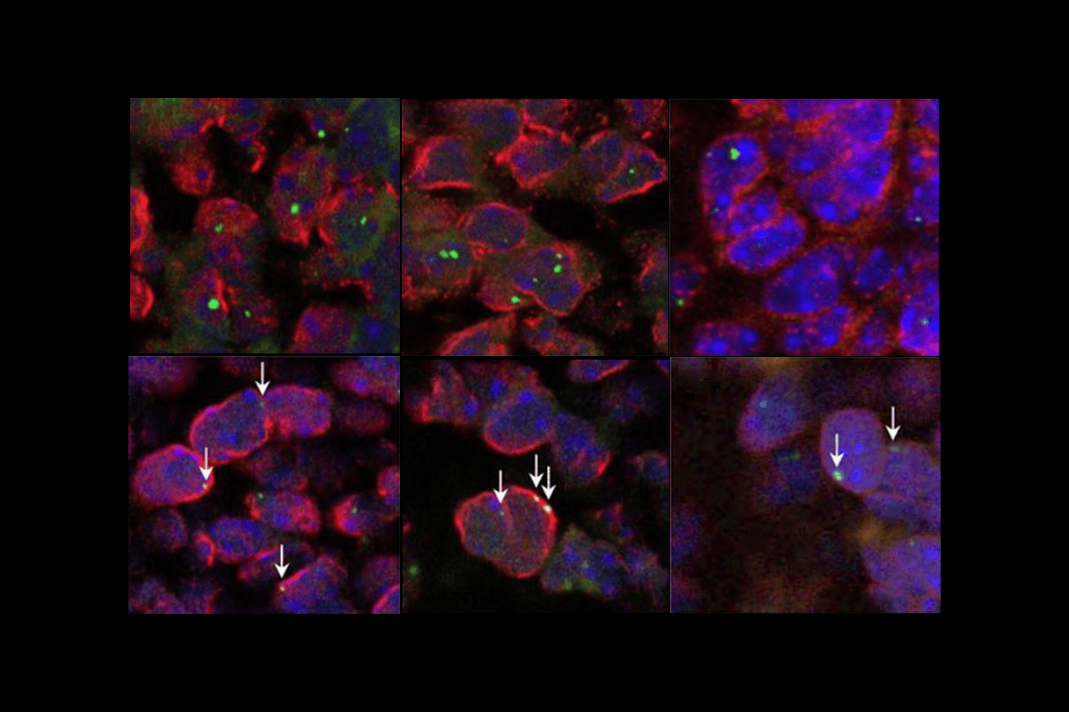 Weekly roundup of autism research news focusing on new biomarker discoveries
